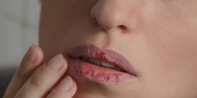 Cara Cegah Bibir Kering saat Menjalani Puasa