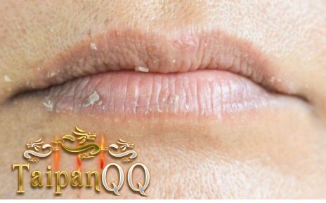 ini dia 5 penyebab luka di bibir ada yang dari alergi sampai herpes
