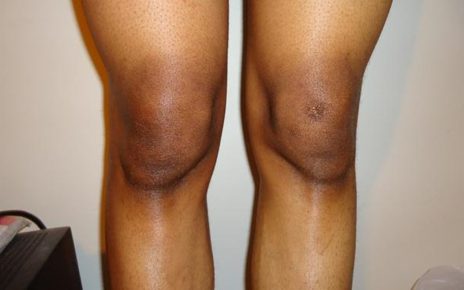 10 Cara Memutihkan Lutut dan Siku, Pakai Bahan Alami